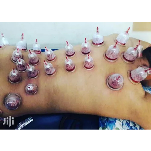 Hijama Therapy